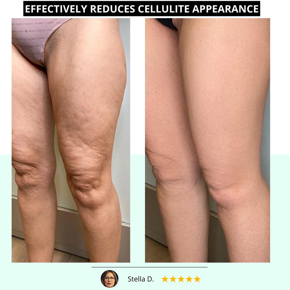 BODYSCULPT PRO™️ <br> Anti-Cellulite & Body Sculpting Device